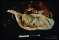 Spleen. Opened cyst.