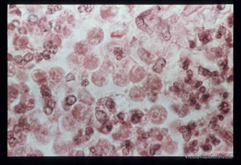 Meningitis- Hematoxylin-eosin stained section of human brain at various magnifications.