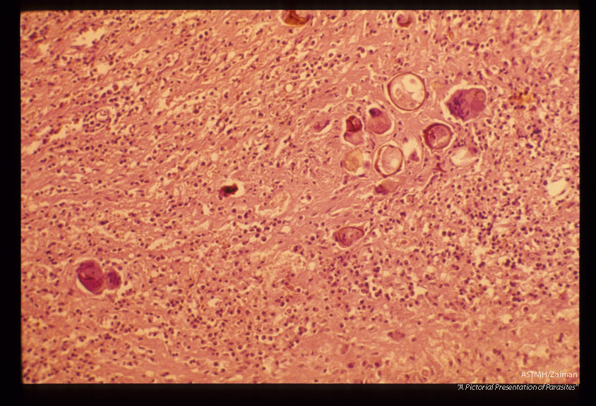 Granulomatous reaction around eggs in pericardium.