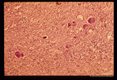 Granulomatous reaction around eggs in pericardium.