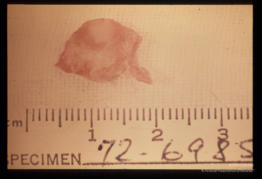 Gross surgical specimen of nodule containing parasite.