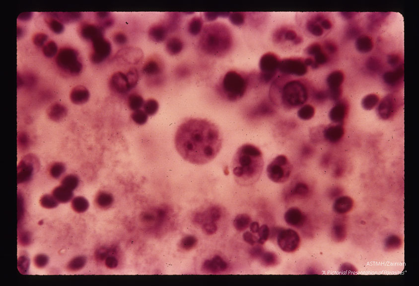 Lee case of primary amoebic meningoencephalitis. Olfactory bulb smear 16 August, multinucleate form.