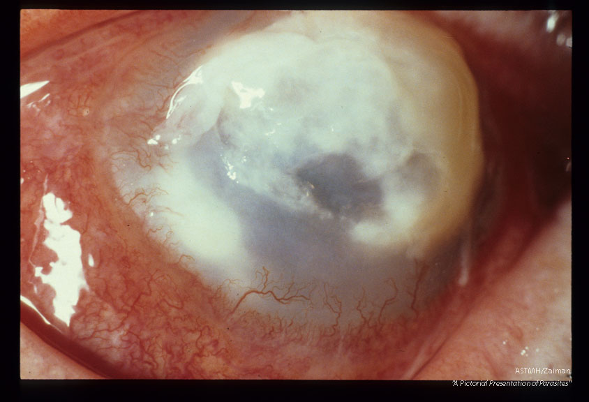 Progressive keratitis in 59 year old male rancher. Slide dated 1-9-74.