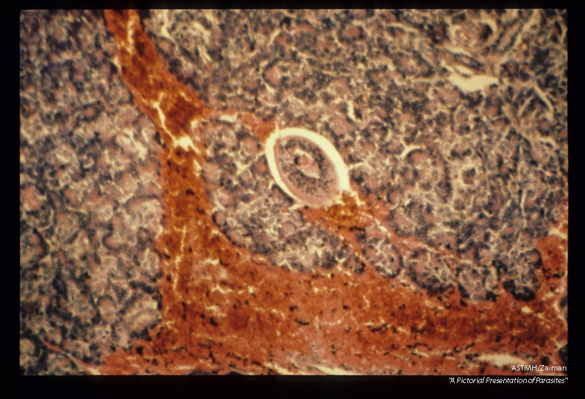 Mesocercaria in the patient's pancreas.
