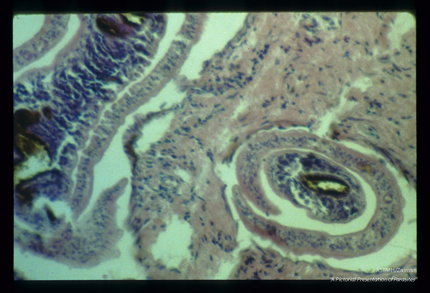 Gross and microscopic photos showing granulomatous formations in testicle as well as adult worm in the pampiniform plexus.