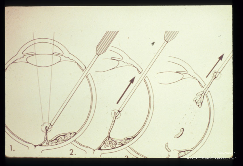 Diagramatic depiction of how cysticercus was removed from the eye.