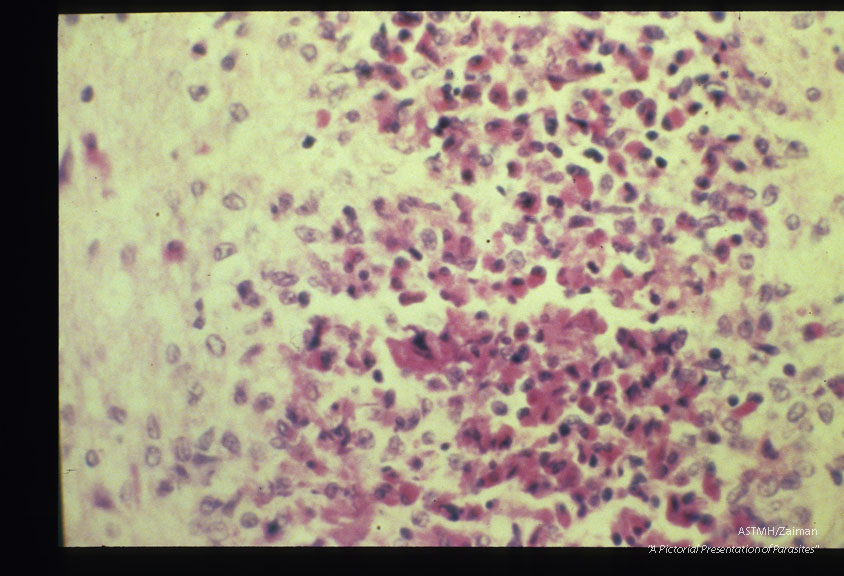 Brain sections from a young male adult who died suddenly and unexpectedly in an institution for the retarded. Larva and brain reaction are well shown.