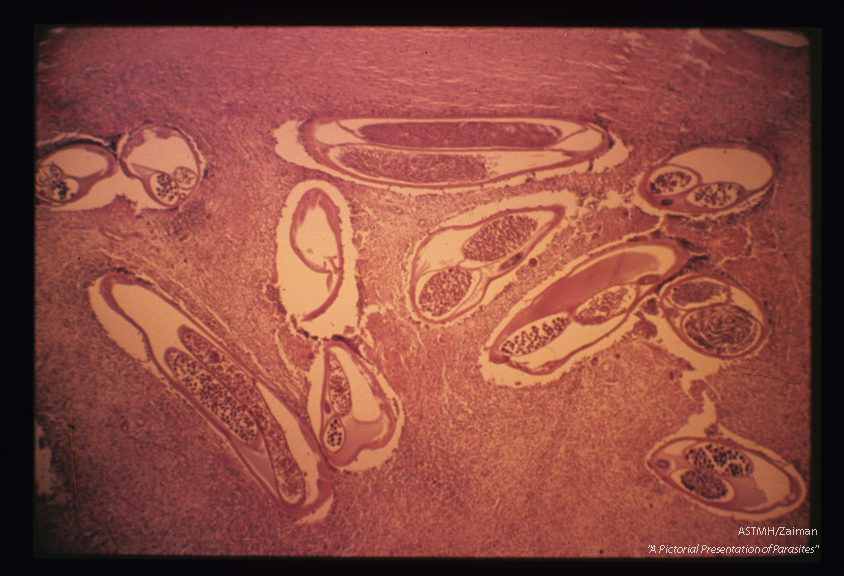 In a subcutaneous nodule. The fibrotic nodule contains coiled up worms which are sectioned in various planes. Note the cuticle, the uterus containing microfilariae in various stages of development and the digestive tract which has a lesser diameter than the uteri.