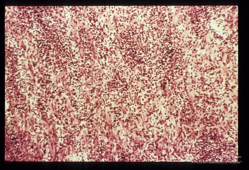 Section of myocardium showing numerous parasites, edema, and inflammatory infiltrate.