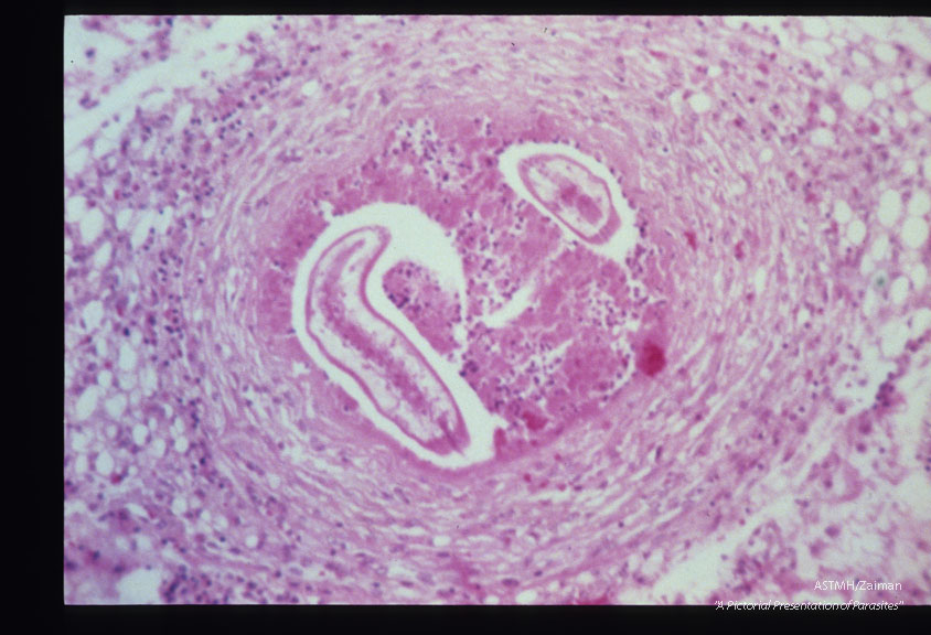 Same case. Mesenteric granuloma with larva.