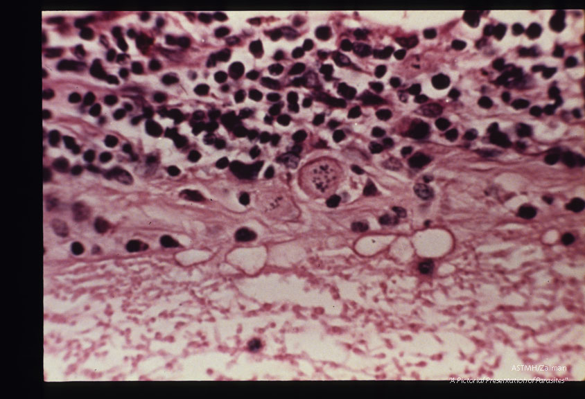 Rabbit retina with newly formed Toxoplasma cyst.
