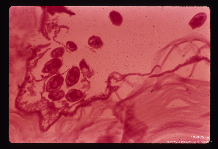 Scolices, proliferative membrane and the laminated eosinophilic membranes are seen.