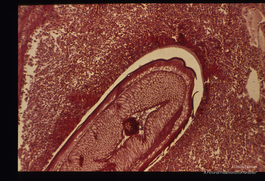 Low and high power magnifications of worm in human stomach wall. Case from Holland.