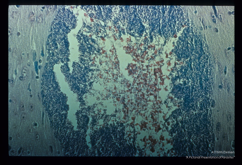 Old cyst from brain Degeneration in center. Giemsa. Collophoninim.