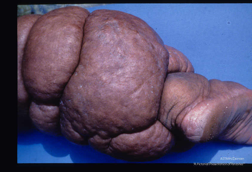 Marked unilateral right elephantiasis in a thirty-eight year old female. Leg is unusually lobulated, hard and lumpy. Acquired twenty-four years earlier.