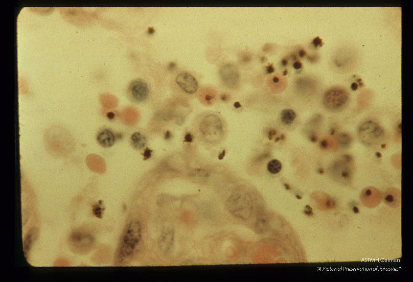 Malaria parasites in maternal placental sinus.