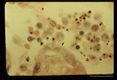 Malaria parasites in maternal placental sinus.