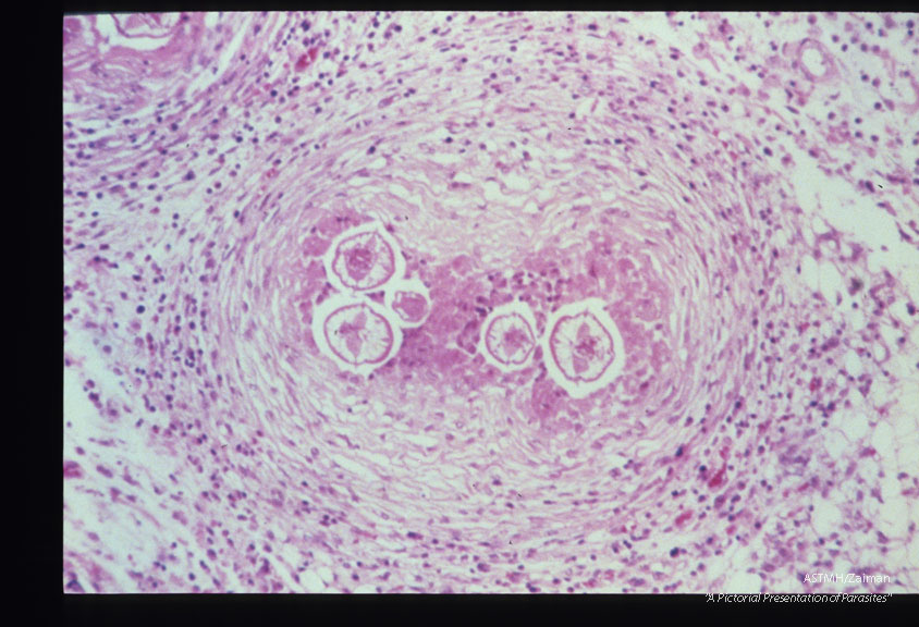 Same case. Mesenteric granuloma with larva.