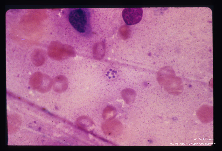 Pneumonia. Touch preparation of similar material.