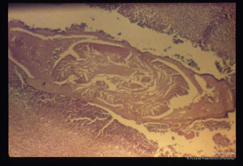 Abdominal mass which contained adult Ascaris (1407, 1408) and eggs (1409) was surgically removed from a patient. There was direct communication with the large bowel. Note cell division in the egg (1409).