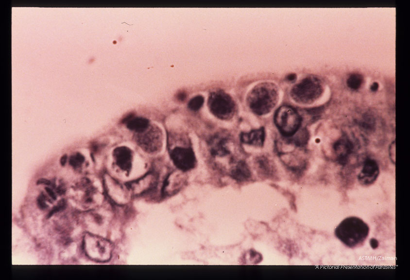 Gametocytes and schizonts. Iron hematoxylin and Giemsa.