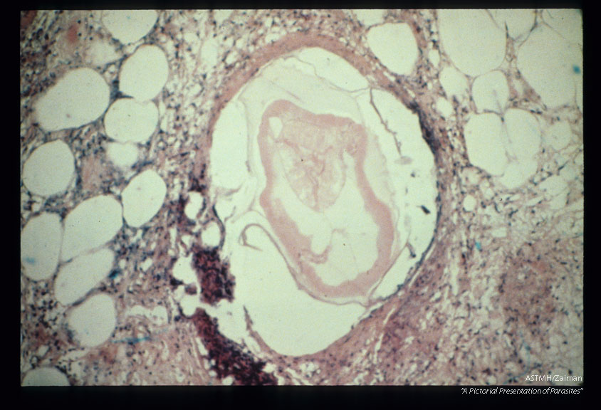 Multiple sections through anisakid nematodes and inflammatory infiltrate they induced in a human cecum.