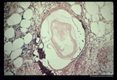Multiple sections through anisakid nematodes and inflammatory infiltrate they induced in a human cecum.
