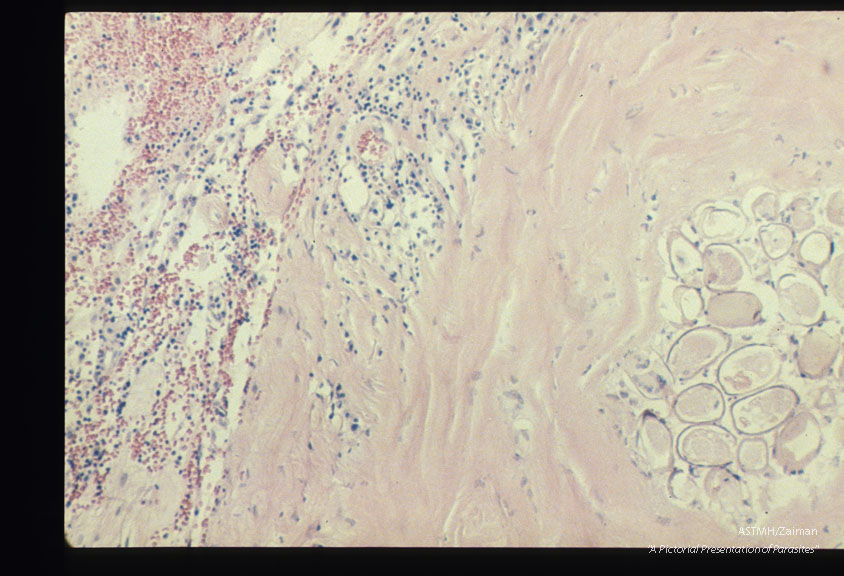 Eggs in the frontal lobe of the brain of a female Korean immigrant.