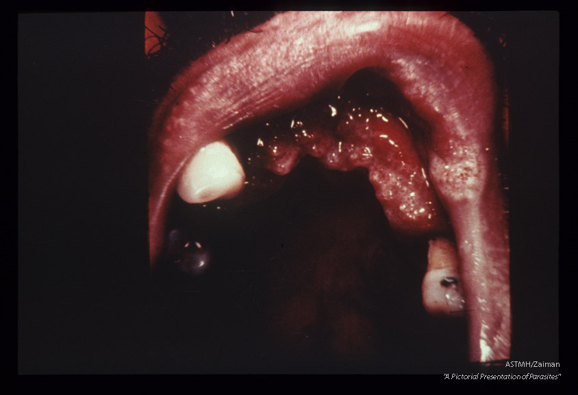 (Brazil). Showing erosion of oral structures.