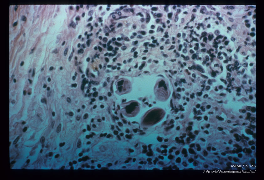 Same case. Portion of adult.