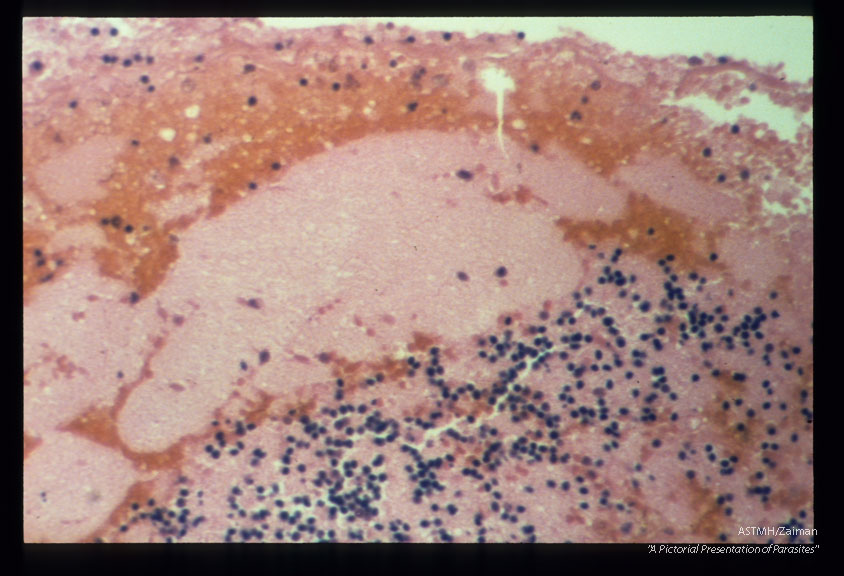 Hemorrhage and inflammation in a cerebellar tonsil.