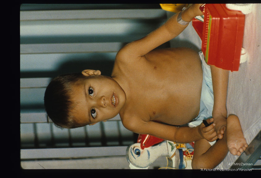 Four year old Puerto Rican patient with multiple parasites including Strongyloides stercoralis, hookworm, Ascaris lumbricoides and Trichuris trichiura. He was small of stature (equivalent to a one and three quarter year old) and his weight was that of a two and a half year old.