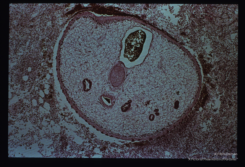 Adult embedded in intestinal wall. The parasite presents as an oval to round mass limited by a spined cuticle. The parasitic parenchyme is punctuated by multiple sections through gut (reddish-brown). The two centrally located tubular structures, separated by a light staining muscular sucker, are part of the reproductive apparatus of the parasite. A marked inflammatory response is present in the adjacent host tissues and fresh red blood cells can be seen near the parasite.