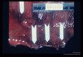 Ulcerations in colon.