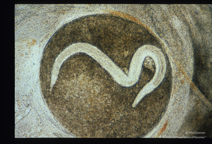 Mouse brain squash preparation shows a larval granuloma 66 days after infection.