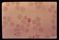 Band form in erythrocyte.