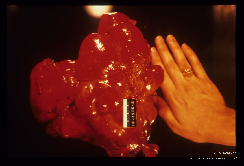 Not all liver cysts are neatly encompassed by the liver! This lobulated mass was cut from the lower edge of a liver.