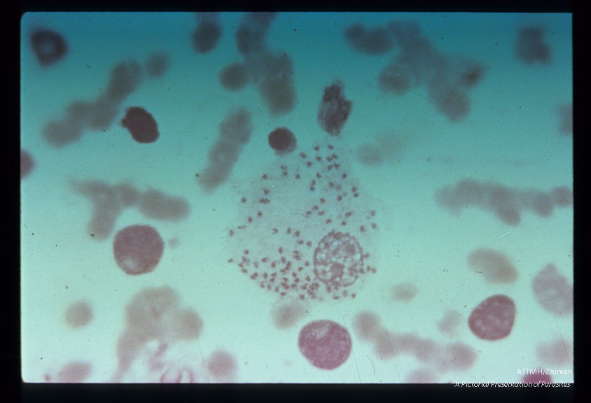 Bone marrow smear from Brazilian patient.