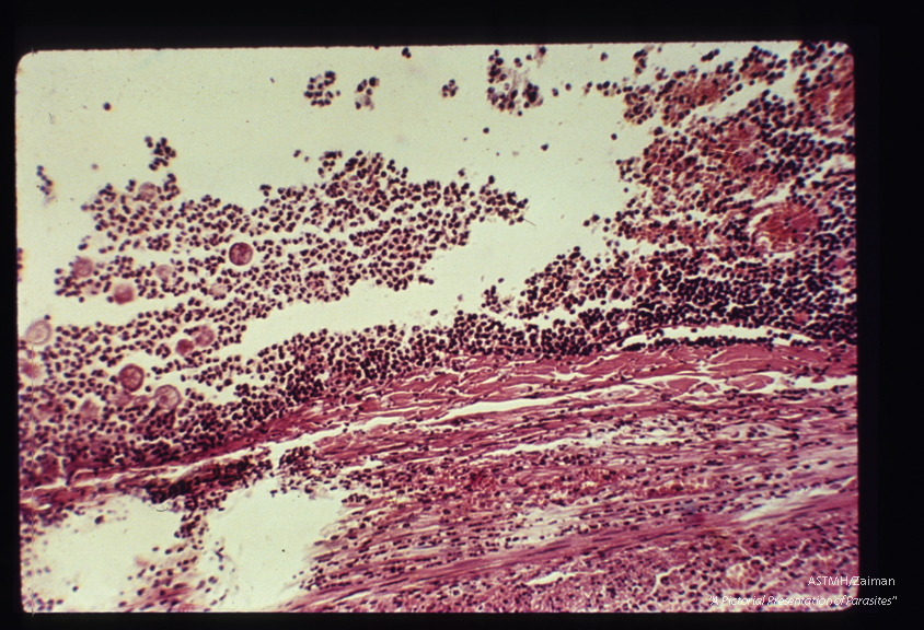 In human appendix; low and high power views of a highly inflamed appendix contain­ing trophozoites . H&E.