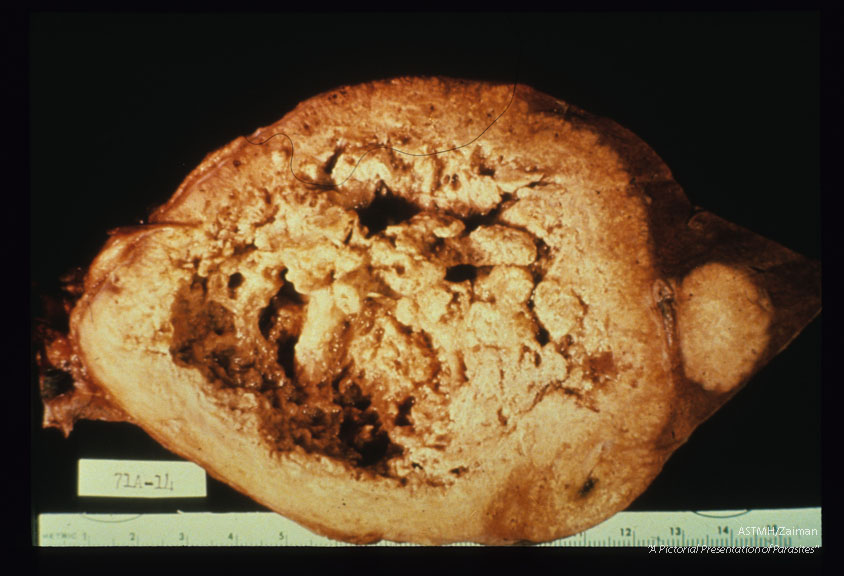 Massive hepatic lesion with central necrosis. Alaska.