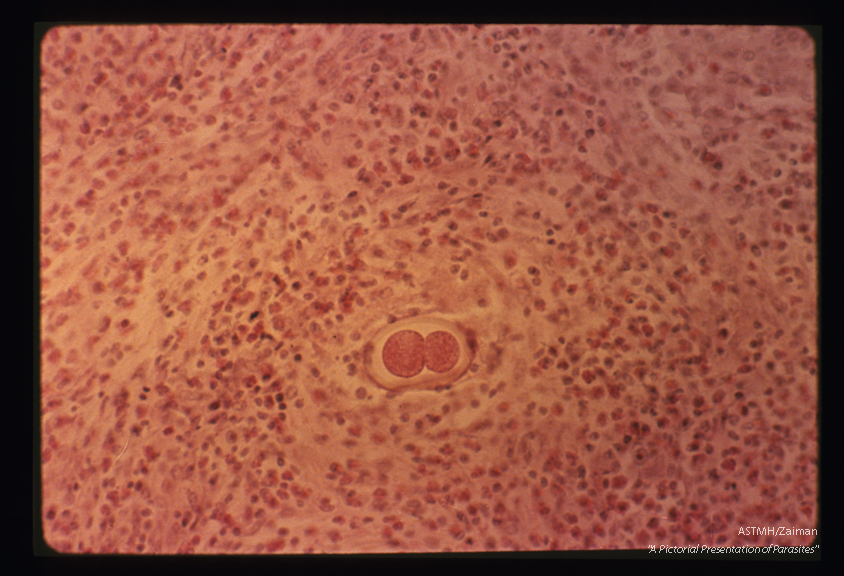 Egg in liver. Wandering adult ascarids may deposit eggs during their travel. This granulomatous reaction was formed around one such egg in the liver. The mamillated coat is lacking but the shell is obvious. The egg shows two cells in this plane.