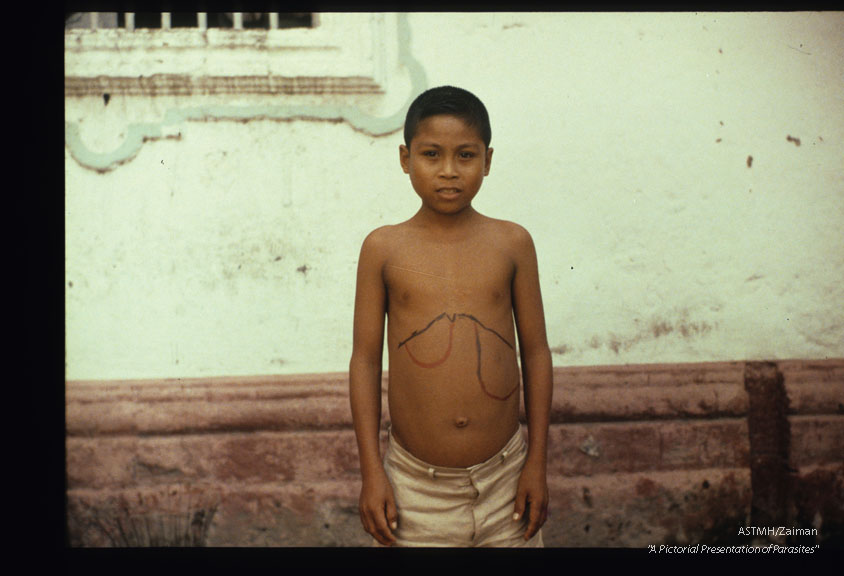 This youngster had Paragonimus westermani, Schistosoma japonica, Ascaris lumbricoides, hookworm, Trichuris trichiura, Taenia, and Entamoeba histolytica. He was from Leyte.