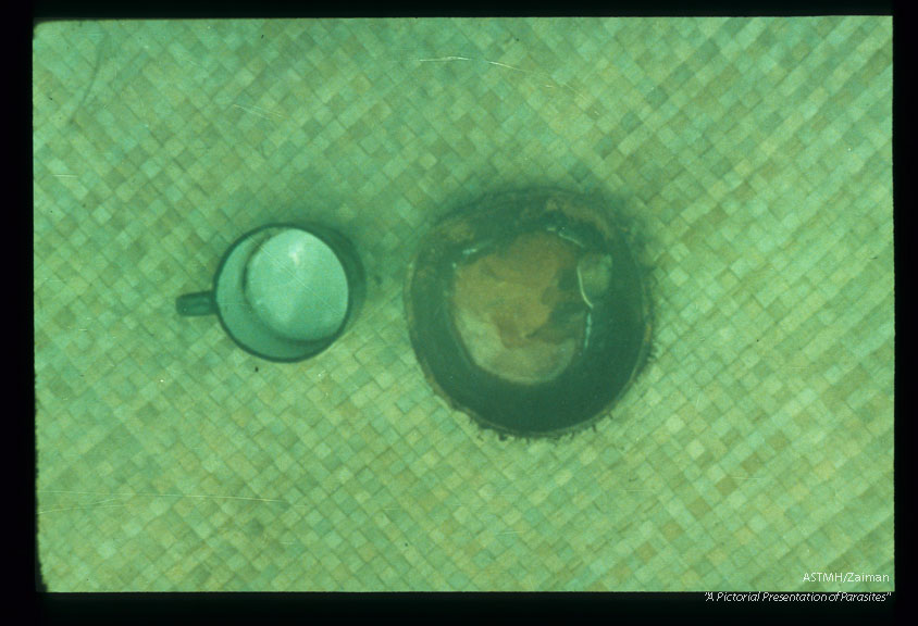 Coconut shell containing drainage from filarial abscess. Cup included to show size relationships.
