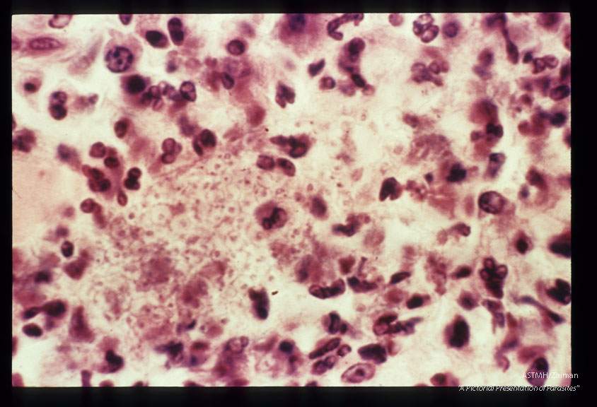 Section of myocardium showing numerous parasites, edema, and inflammatory infiltrate.