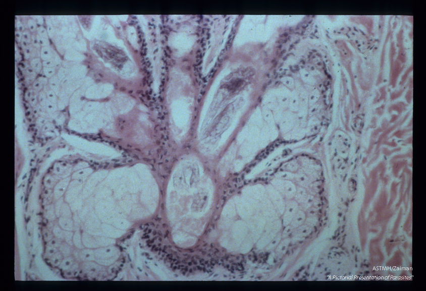 More or less complete longitudinal sections through three parasites in hair follicles.