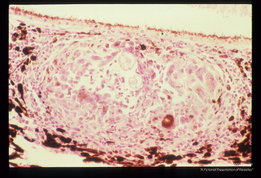 Choroidal granuloma in an experimentally infected cynomolgus monkey.