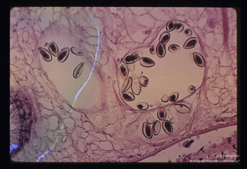 Eggs in adult within the bile duct. Note the way the operculum fits the rest of the egg.