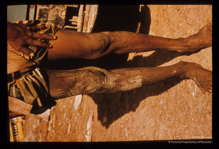 Adult man with typical sowda of the right leg with many lesions from scratching in response to severe itching. Wadi Al Barh, Yemen Arab Republic.